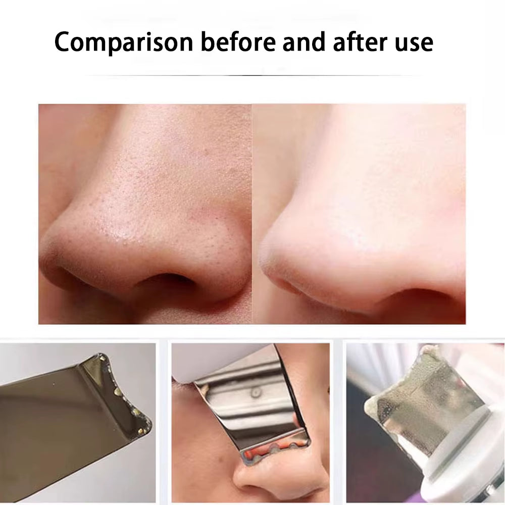 Blackhead Remover Deep Facial Cleansing Spatula Face Cleaning Lift Machine Peeling Shovel Pore Cleaner Black Dot Sebum Remover